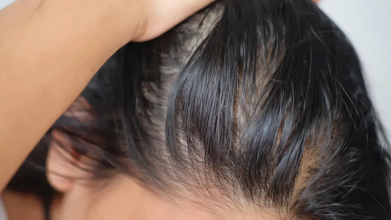 Nahaufnahme von fettigen Haaren, die nach Tipps gegen fettige Haare suchen. Die Kopfhaut ist sichtbar, die Haare wirken strähnig.