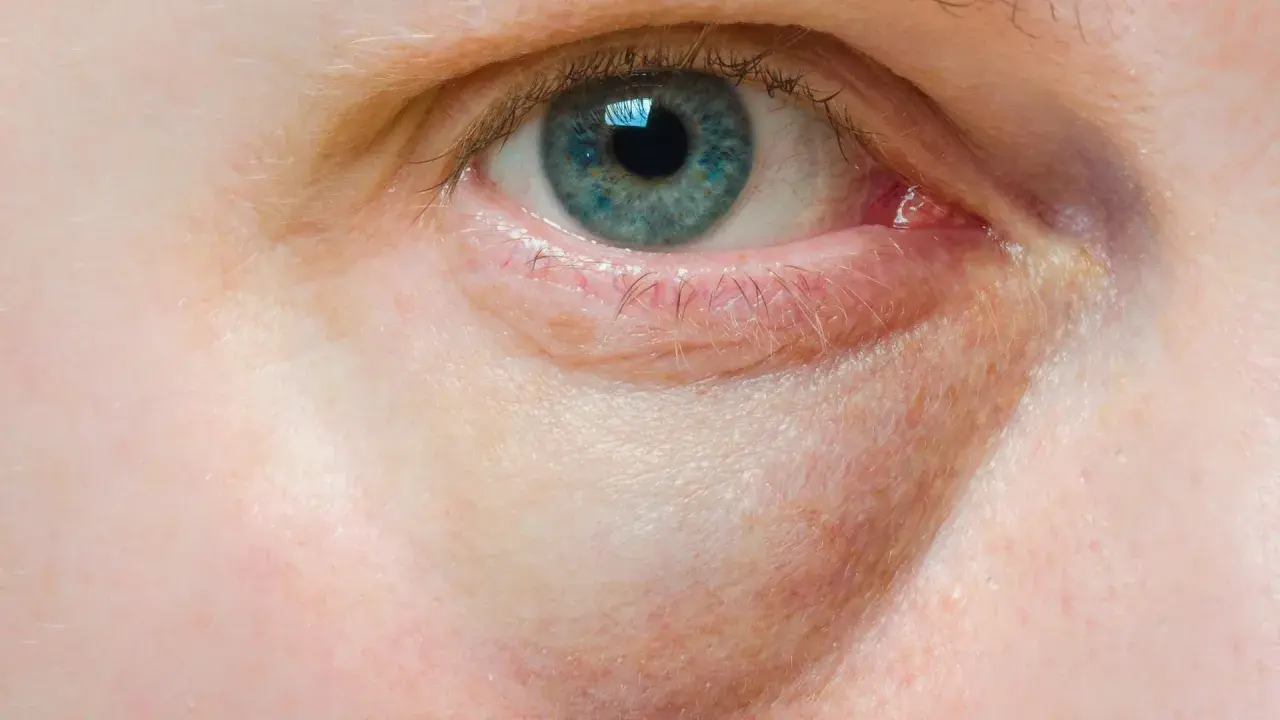 Nahaufnahme eines blauen Auges mit deutlichen gelben Augenringen, die auf Müdigkeit oder eine Verletzung hindeuten.