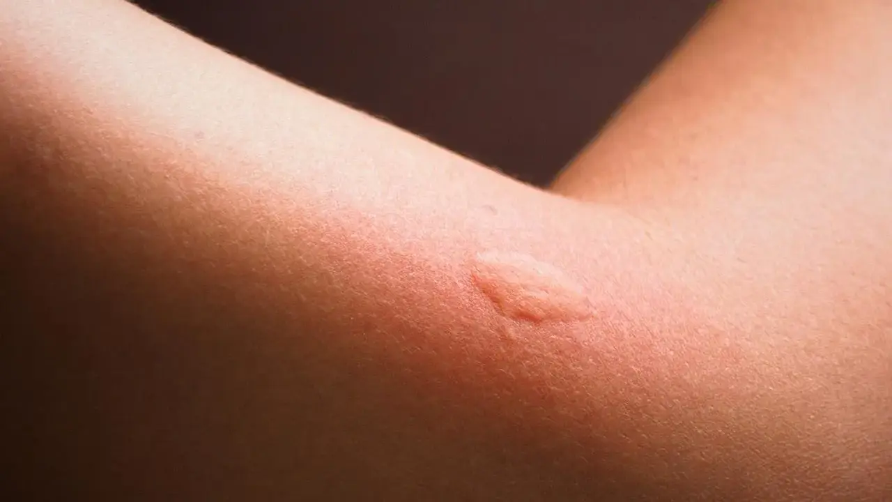 Rote, geschwollene Stelle am Arm, die auf eine panthenol allergie hindeuten könnte.