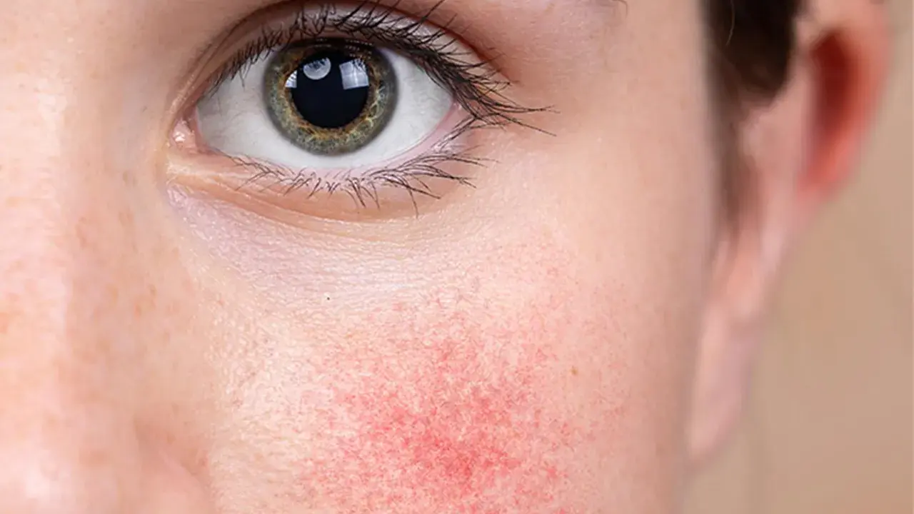 Nahaufnahme eines Gesichts mit geröteter Haut um das Auge, Anzeichen von periorbitaler Dermatitis.