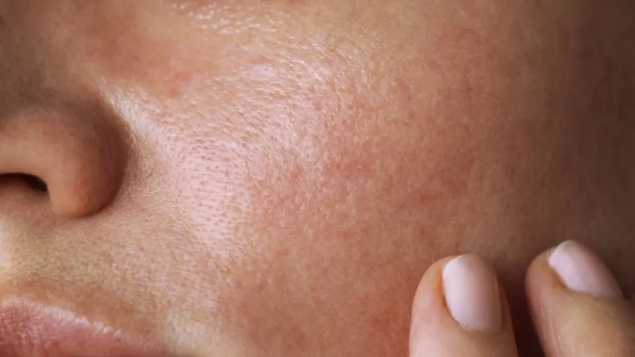 Nahaufnahme der Haut mit sichtbaren Poren und Rötungen. Eine Hand berührt sanft die Wange, als ob sie die Talgproduktion reduzieren möchte.