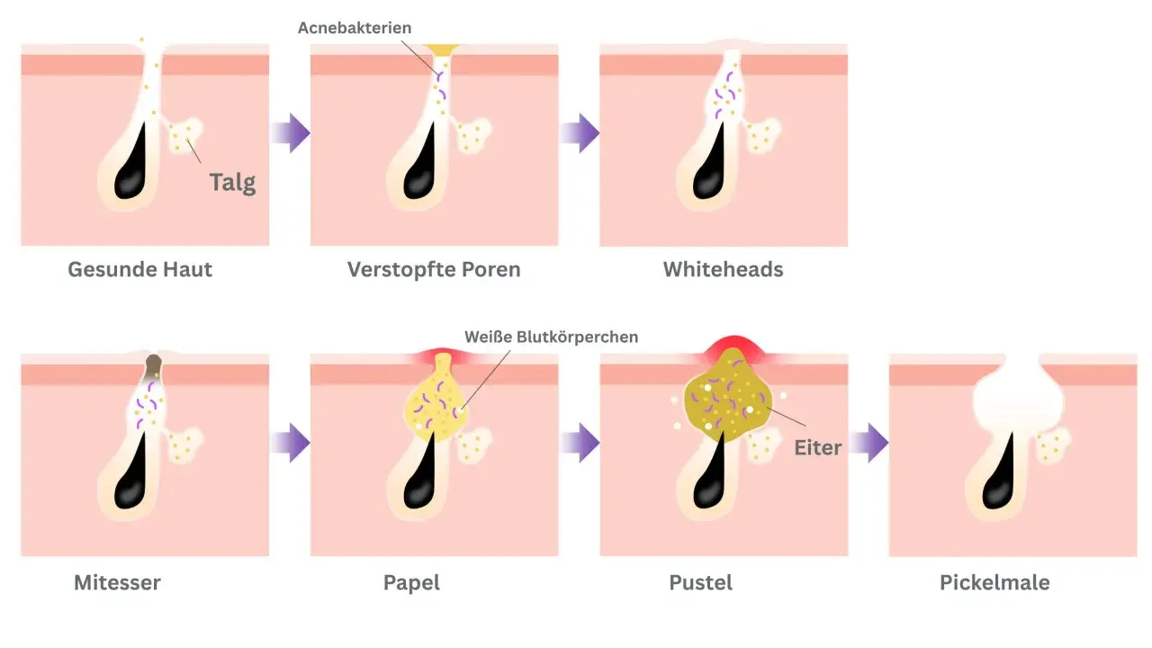 Illustration zeigt, wie Mitesser aussehen: von gesunder Haut über verstopfte Poren und Whiteheads bis zu Pickelmalen.