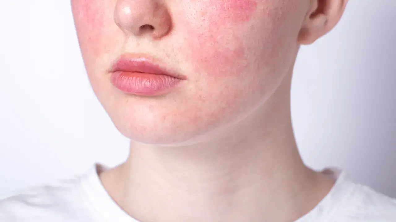 Rötungen im Gesicht, die auf Hautprobleme durch Stress hindeuten. Die Wangen sind gerötet, die Lippen und die Nase sind sichtbar.
