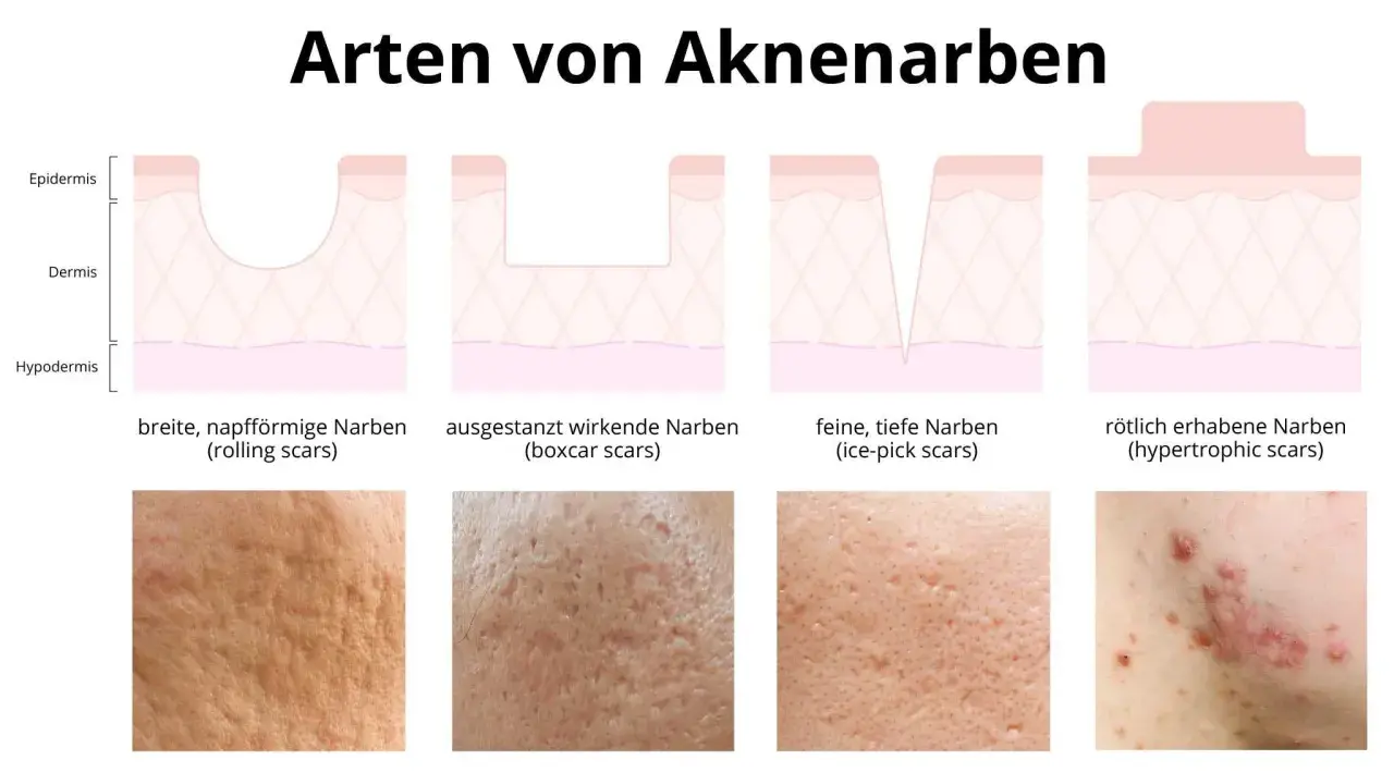 Illustrationen zeigen verschiedene Arten von Aknenarben: rollende, ausgestanzte, eisgepickte und erhabene Narben. Diese sind oft das Ergebnis von Pickelmalen.