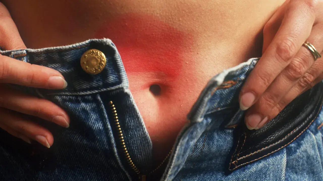 Gerötete Haut am Bauch, möglicherweise durch eine Nickelallergie. Hausmittel können Linderung verschaffen.