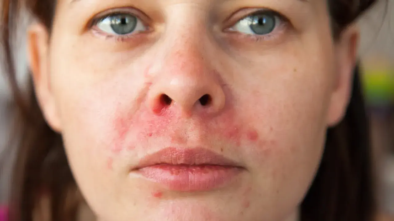 Nahaufnahme eines Gesichts mit perioraler Dermatitis, die sich durch Rötungen und Schuppen um Mund und Nase zeigt.