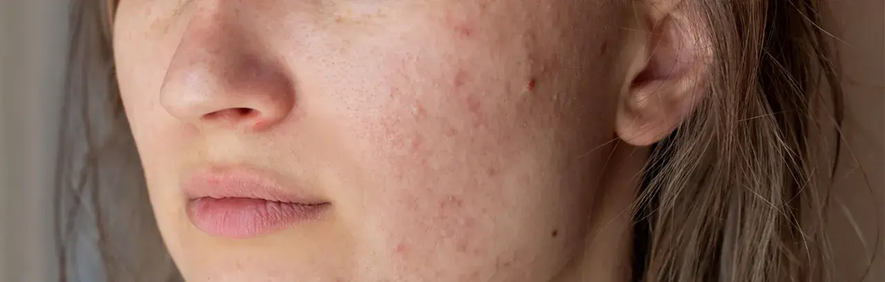 Nahaufnahme eines Gesichts mit Rötungen und Pickelchen um den Mund. Periorale Dermatitis: Nulltherapie hilft nicht.