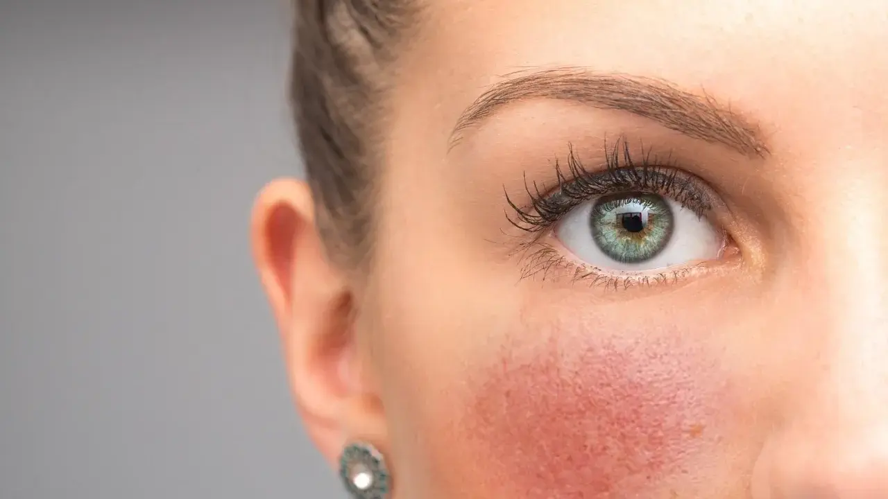 Nahaufnahme eines Gesichts mit geröteten Wangen. Tipps zur **Rosacea vorbeugen** helfen, die Haut zu beruhigen.