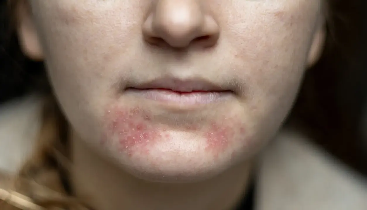 Nahaufnahme des Gesichts einer jungen Frau mit geröteten, entzündeten Stellen und kleinen Pickeln im Kinnbereich.