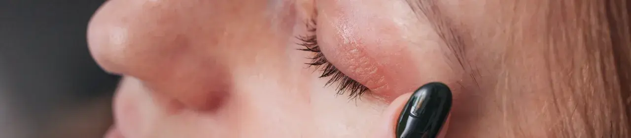 Nahaufnahme einer trockenen Stelle unterm Auge, die mit einem dunklen Nagellackstift berührt wird.