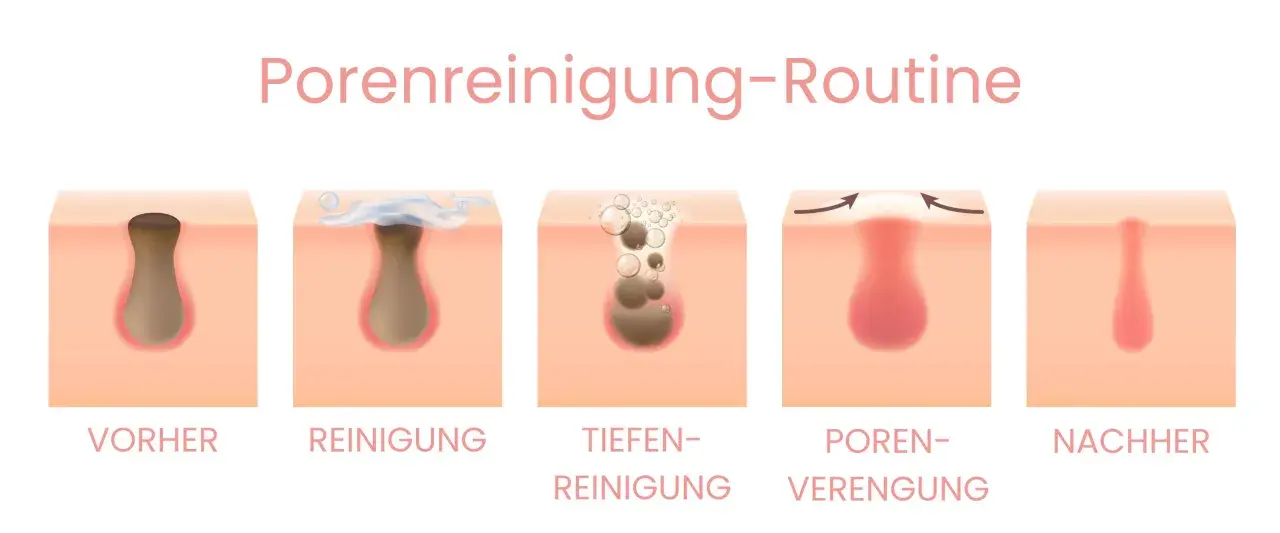 Illustration zeigt die Reinigung von Poren, die schwarze Punkte auf der Haut enthalten. Die Schritte umfassen Vorher, Reinigung, Tiefenreinigung, Porenverengung und Nachher.