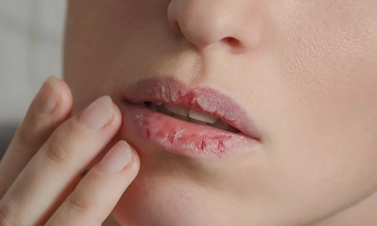 Trockene, rissige Lippen, die fast platzen auf, werden von einer Hand berührt.