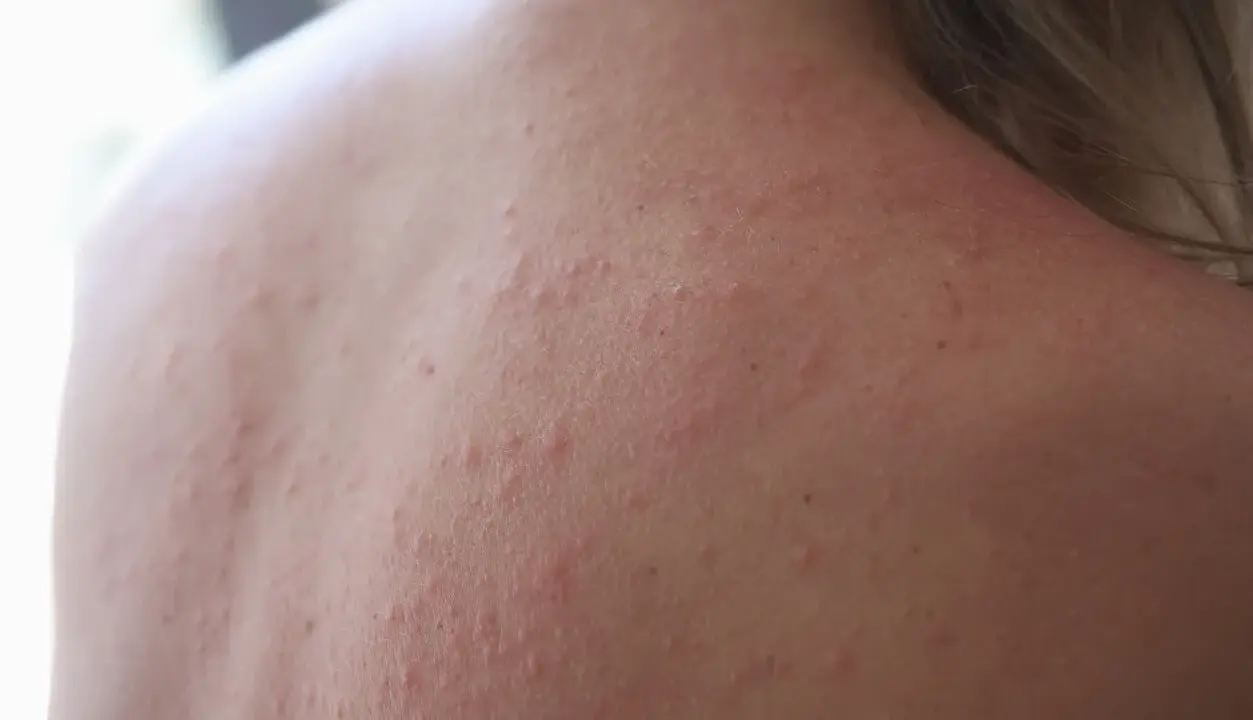 Roter Hautausschlag am Rücken, trockene Haut, möglicherweise ein Hautausschlag durch Stress.
