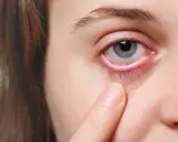 Ein blasses Gesicht mit gereiztem, rotem Augenlid, das von einer Fingerspitze berührt wird.