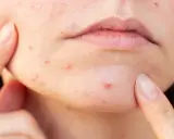 Nahaufnahme von Haut mit Pickeln und Mitessern, die von Fingern berührt werden.