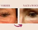 Vorher/Nachher-Vergleich: Reduzierung von Lymphstau im Augenbereich durch sanfte Massage.
