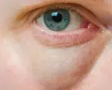 Nahaufnahme eines blauen Auges mit deutlichen gelben Augenringen, die auf Müdigkeit oder eine Verletzung hindeuten.