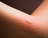 Rote, geschwollene Stelle am Arm, die auf eine panthenol allergie hindeuten könnte.