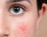 Nahaufnahme eines Gesichts mit geröteter Haut um das Auge, Anzeichen von periorbitaler Dermatitis.