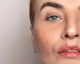 Nahaufnahme eines Gesichts mit Sommersprossen und einem Nasenring. Die Haut zeigt Anzeichen von haut regeneration.