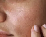 Nahaufnahme der Haut mit sichtbaren Poren und Rötungen. Eine Hand berührt sanft die Wange, als ob sie die Talgproduktion reduzieren möchte.