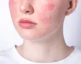 Rötungen im Gesicht, die auf Hautprobleme durch Stress hindeuten. Die Wangen sind gerötet, die Lippen und die Nase sind sichtbar.