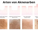 Illustrationen zeigen verschiedene Arten von Aknenarben: rollende, ausgestanzte, eisgepickte und erhabene Narben. Diese sind oft das Ergebnis von Pickelmalen.