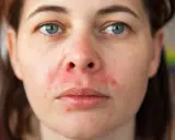 Nahaufnahme eines Gesichts mit perioraler Dermatitis, die sich durch Rötungen und Schuppen um Mund und Nase zeigt.