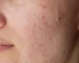 Nahaufnahme eines Gesichts mit Rötungen und Pickelchen um den Mund. Periorale Dermatitis: Nulltherapie hilft nicht.