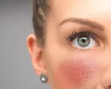 Nahaufnahme eines Gesichts mit geröteten Wangen. Tipps zur **Rosacea vorbeugen** helfen, die Haut zu beruhigen.