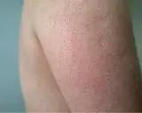 Haut mit vielen kleinen roten Pickeln am Oberarm, die wie Gänsehaut aussehen.