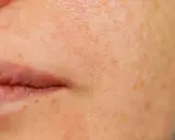 Nahaufnahme der Haut mit sichtbaren Poren und Sommersprossen. Eine sanfte Pflege, was verfeinert die Poren, kann das Hautbild verbessern.