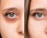 Vorher/Nachher-Vergleich: Deutlich sichtbare dunkle Augenringe werden reduziert.