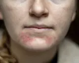 Nahaufnahme des Gesichts einer jungen Frau mit geröteten, entzündeten Stellen und kleinen Pickeln im Kinnbereich.