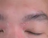 Schuppige Haut um die Augen und Augenbrauen, Anzeichen von Kopfgneis.