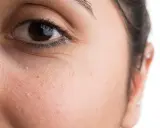 Nahaufnahme eines Gesichts mit sichtbaren Milien unter dem Auge.