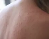 Roter Hautausschlag am Rücken, trockene Haut, möglicherweise ein Hautausschlag durch Stress.