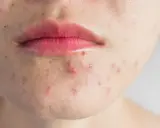 Nahaufnahme von Mund und Kinn mit trockener Haut und Pickeln. Rote Entzündungen und Mitesser sind sichtbar.