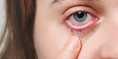 Ein blasses Gesicht mit gereiztem, rotem Augenlid, das von einer Fingerspitze berührt wird.