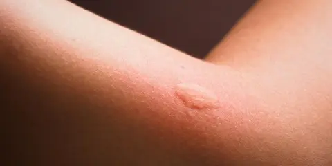 Rote, geschwollene Stelle am Arm, die auf eine panthenol allergie hindeuten könnte.