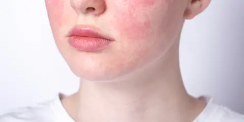 Rötungen im Gesicht, die auf Hautprobleme durch Stress hindeuten. Die Wangen sind gerötet, die Lippen und die Nase sind sichtbar.