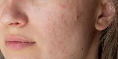 Nahaufnahme eines Gesichts mit Rötungen und Pickelchen um den Mund. Periorale Dermatitis: Nulltherapie hilft nicht.