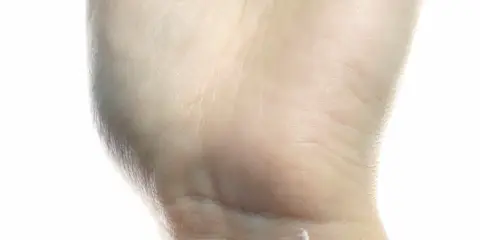 Eine Hand mit trockener Haut, die eine kleine Wunde mit Salbe versorgt. Ein Zeichen für einen Mangel an Feuchtigkeit.