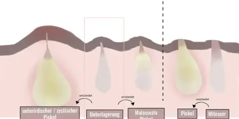 Illustration zeigt, wie unterirdische Pickel entstehen: von Unterlagerung über Malassezia-Pickel bis zu sichtbaren Pickeln und Mitessern.
