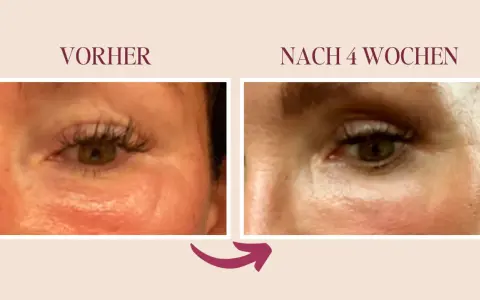 Vorher/Nachher-Vergleich: Reduzierung von Lymphstau im Augenbereich durch sanfte Massage.
