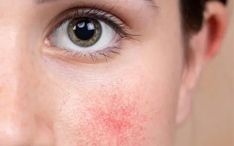 Nahaufnahme eines Gesichts mit geröteter Haut um das Auge, Anzeichen von periorbitaler Dermatitis.