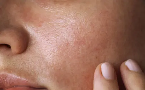 Nahaufnahme der Haut mit sichtbaren Poren und Rötungen. Eine Hand berührt sanft die Wange, als ob sie die Talgproduktion reduzieren möchte.