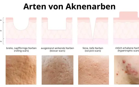 Illustrationen zeigen verschiedene Arten von Aknenarben: rollende, ausgestanzte, eisgepickte und erhabene Narben. Diese sind oft das Ergebnis von Pickelmalen.