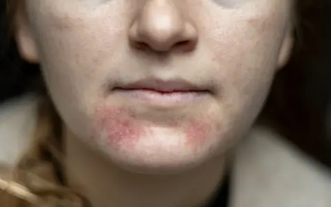 Nahaufnahme des Gesichts einer jungen Frau mit geröteten, entzündeten Stellen und kleinen Pickeln im Kinnbereich.