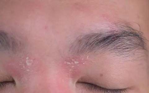 Schuppige Haut um die Augen und Augenbrauen, Anzeichen von Kopfgneis.